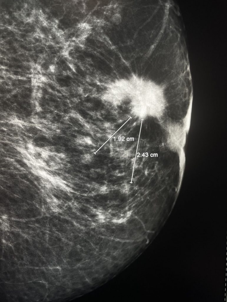Рак на гърда - рентген